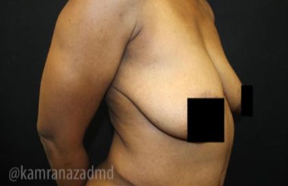 Breast Lift Before & After Patient #2282