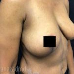 Breast Lift Before & After Patient #2282