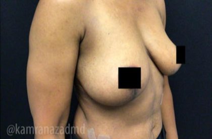 Breast Lift Before & After Patient #2282