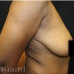 Breast Lift Before & After Patient #2282