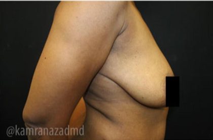 Breast Lift Before & After Patient #2282