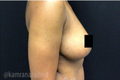 Breast Lift Before & After Patient #2282