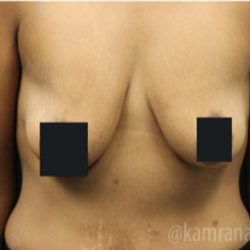 Breast Lift Before & After Patient #2283