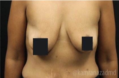 Breast Lift Before & After Patient #2283