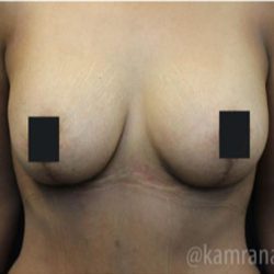 Breast Lift Before & After Patient #2283
