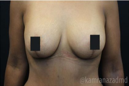 Breast Lift Before & After Patient #2283