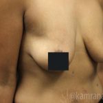 Breast Lift Before & After Patient #2283