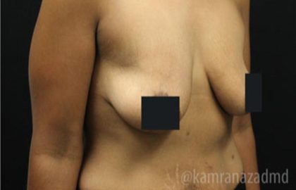 Breast Lift Before & After Patient #2283