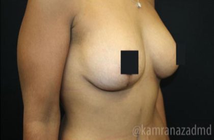 Breast Lift Before & After Patient #2283
