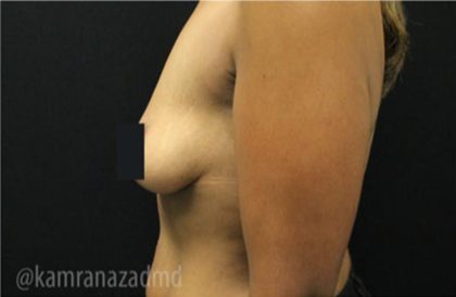 Breast Lift Before & After Patient #2283