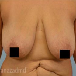 Breast Lift Before & After Patient #2284