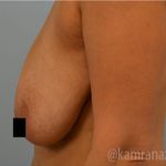 Breast Lift Before & After Patient #2284