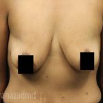 Breast Lift Before & After Patient #2285