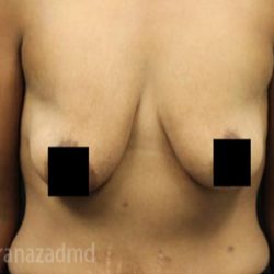 Breast Lift Before & After Patient #2285