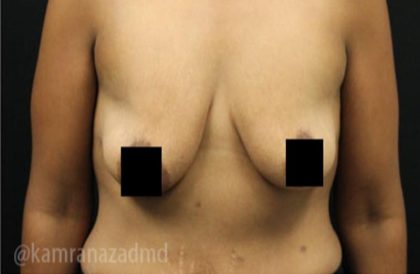 Breast Lift Before & After Patient #2285