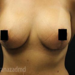 Breast Lift Before & After Patient #2285