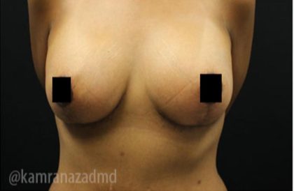 Breast Lift Before & After Patient #2285