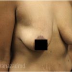 Breast Lift Before & After Patient #2285