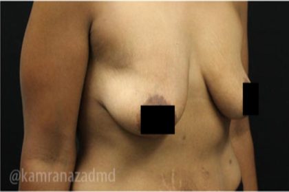 Breast Lift Before & After Patient #2285