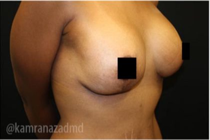Breast Lift Before & After Patient #2285