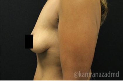 Breast Lift Before & After Patient #2285