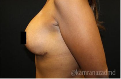 Breast Lift Before & After Patient #2285