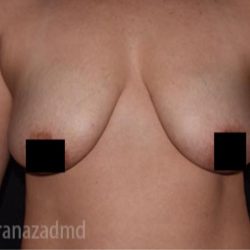 Breast Lift Before & After Patient #2286