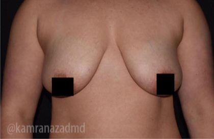 Breast Lift Before & After Patient #2286