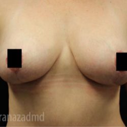 Breast Lift Before & After Patient #2286