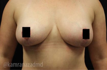 Breast Lift Before & After Patient #2286