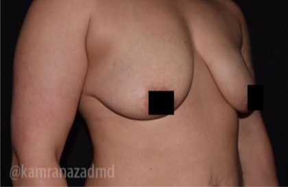 Breast Lift Before & After Patient #2286