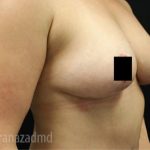 Breast Lift Before & After Patient #2286