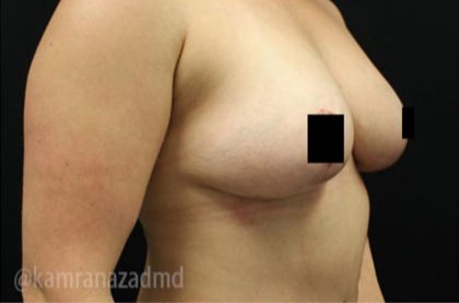 Breast Lift Before & After Patient #2286