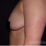 Breast Lift Before & After Patient #2286