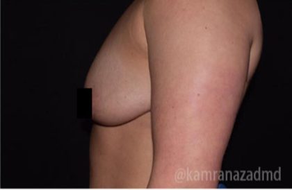 Breast Lift Before & After Patient #2286