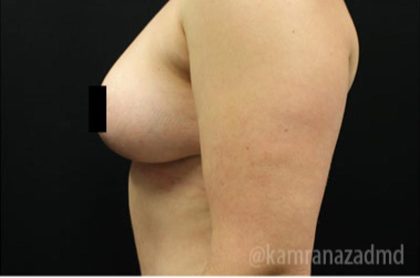 Breast Lift Before & After Patient #2286