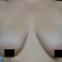 Breast Lift Before & After Patient #2287