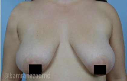 Breast Lift Before & After Patient #2287