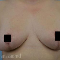 Breast Lift Before & After Patient #2287
