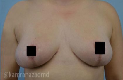Breast Lift Before & After Patient #2287