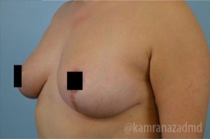 Breast Lift Before & After Patient #2287
