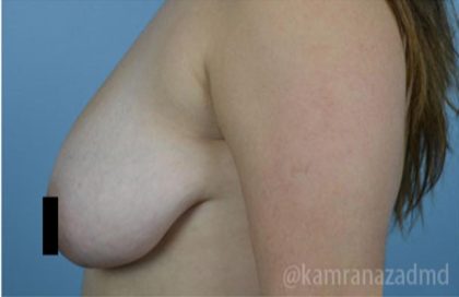 Breast Lift Before & After Patient #2287