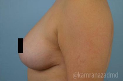 Breast Lift Before & After Patient #2287
