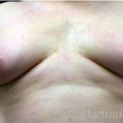 Gynecomastia Before & After Patient #2317