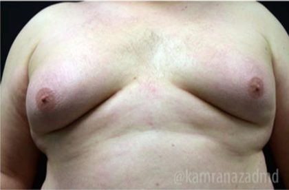 Gynecomastia Before & After Patient #2317