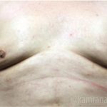 Gynecomastia Before & After Patient #2317