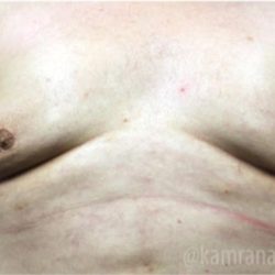 Gynecomastia Before & After Patient #2317