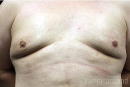 Gynecomastia Before & After Patient #2317