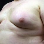 Gynecomastia Before & After Patient #2317