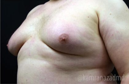 Gynecomastia Before & After Patient #2317